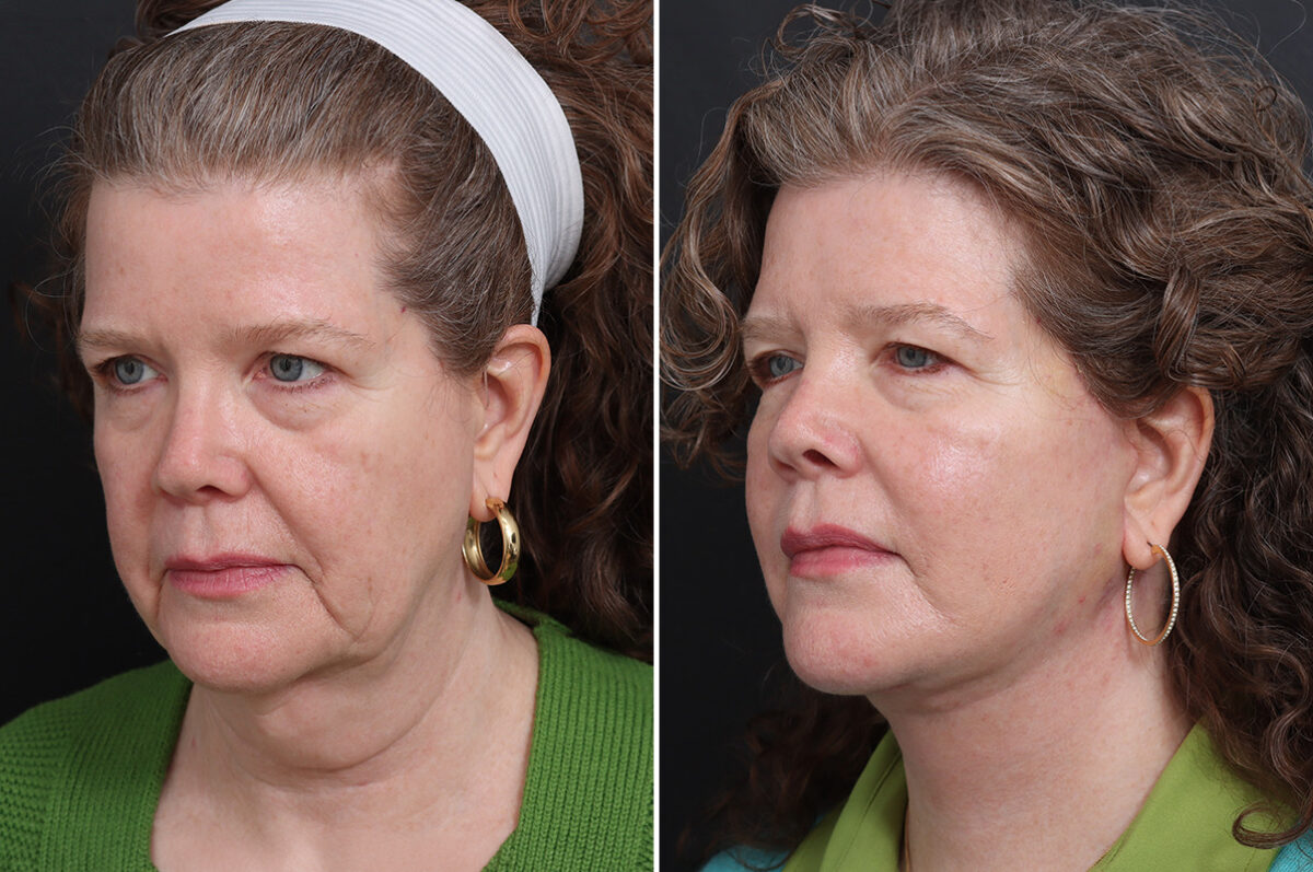 Facelift Before and After Photos in Princeton, NJ, Patient 17270