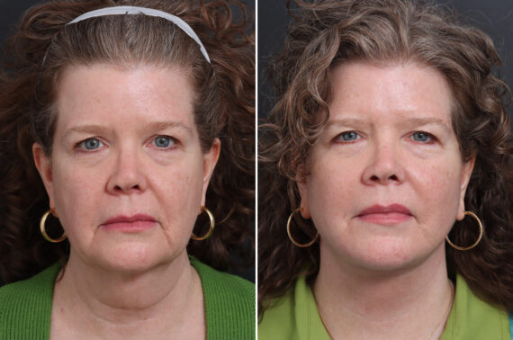 Facelift Before and After Photos in Princeton, NJ