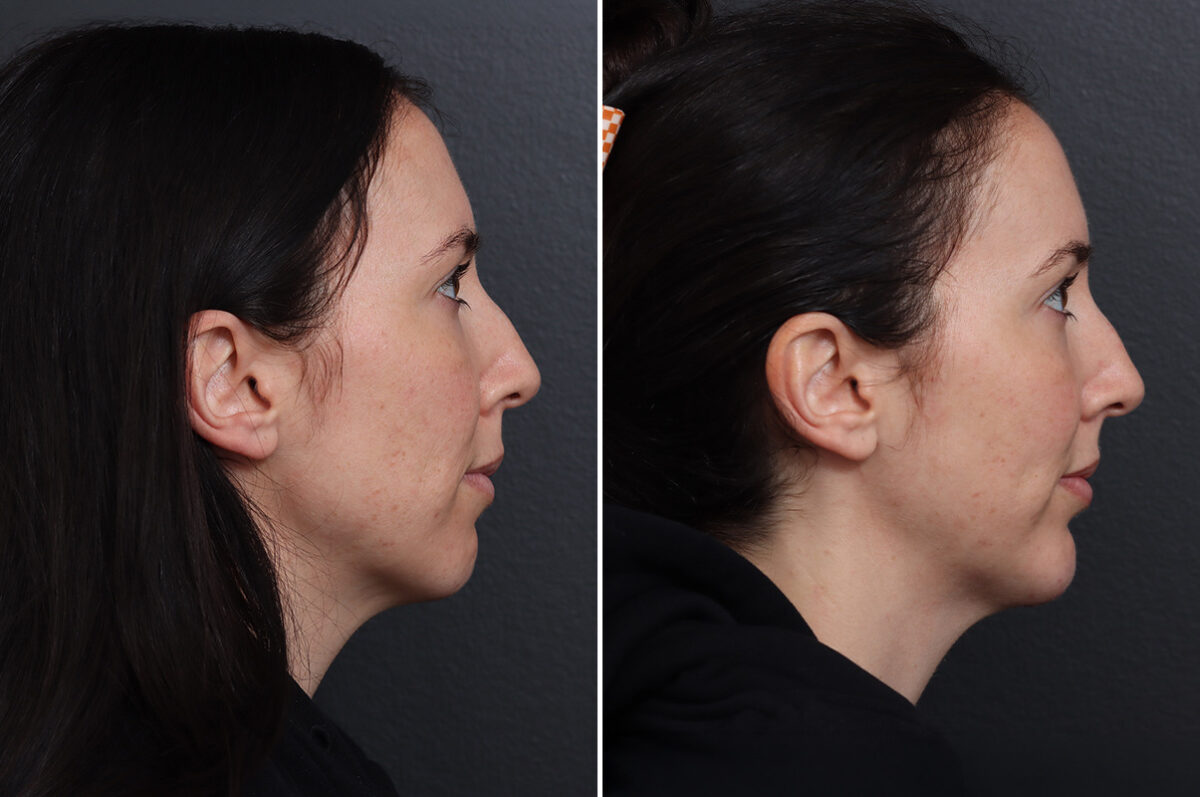 Chin Implants Before and After Photos in Princeton, NJ, Patient 17280