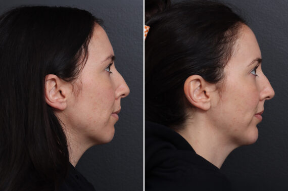 Chin Implants Before and After Photos in Princeton, NJ, Patient 17280