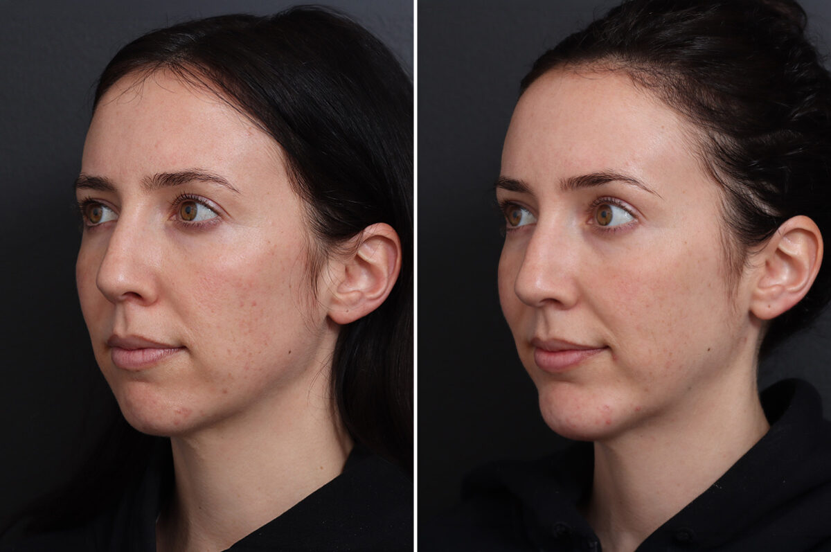 Chin Implants Before and After Photos in Princeton, NJ, Patient 17280