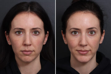 Chin Implants Before and After Photos in Princeton, NJ, Patient 17280