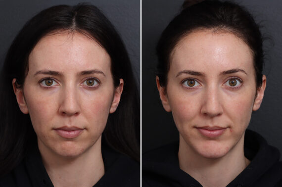 Chin Implants Before and After Photos in Princeton, NJ, Patient 17280