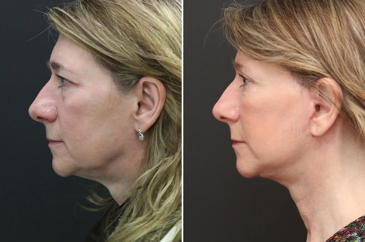 Facelift Before and After Photos in Princeton, NJ, Patient 9068