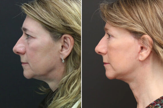Facelift Before and After Photos in Princeton, NJ, Patient 9068