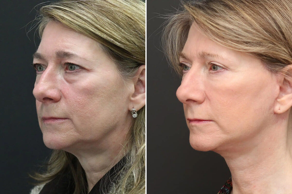Facelift Before and After Photos in Princeton, NJ, Patient 9068