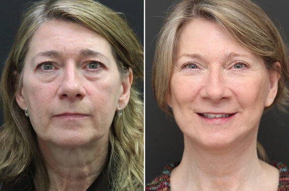 Facelift Before and After Photos in Princeton, NJ, Patient 9068