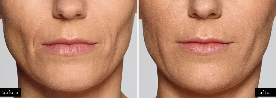 Restylane Defyne