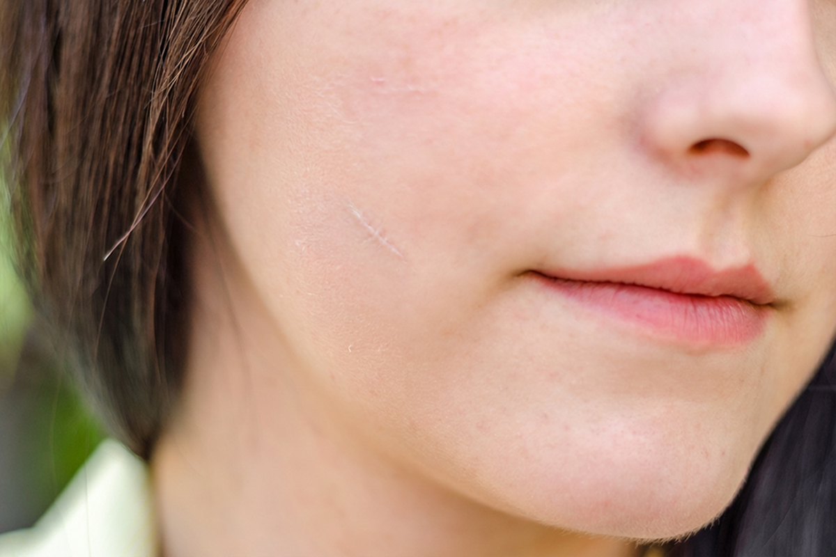 Close-up of smoother skin after scar treatment improving texture and reducing visible scarring