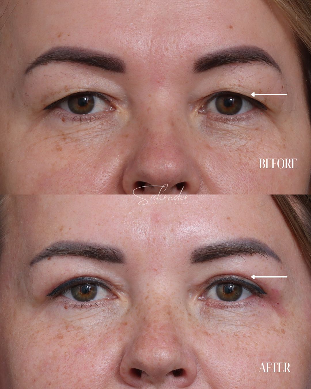 blepharoplasty-01-front