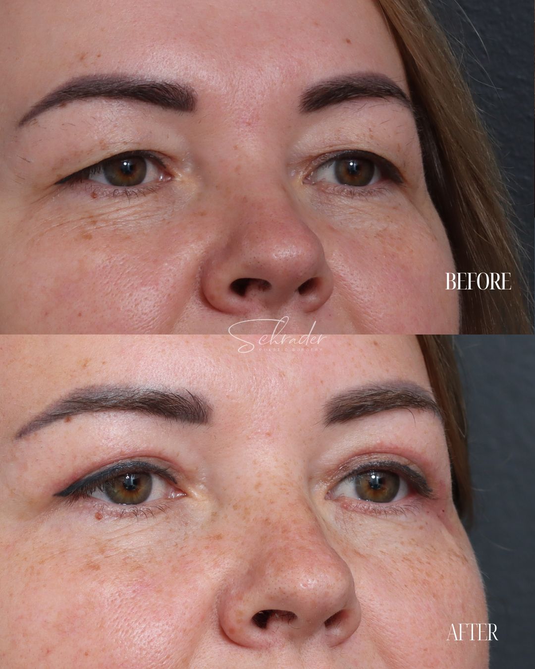 blepharoplasty-01-obl-right