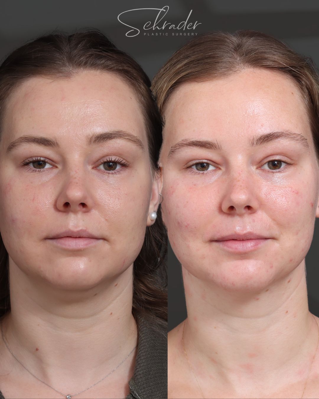 chin-liposuction-10-front