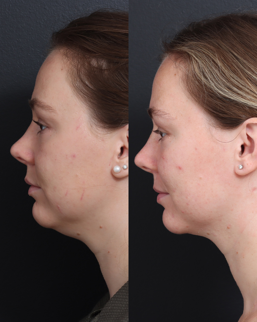 chin-liposuction-10-lat-l