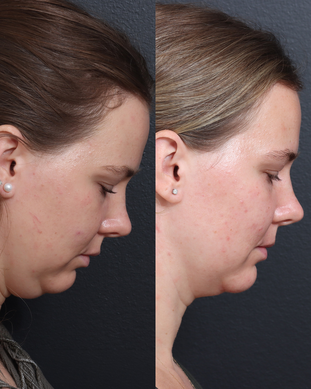 chin-liposuction-10-lat-r