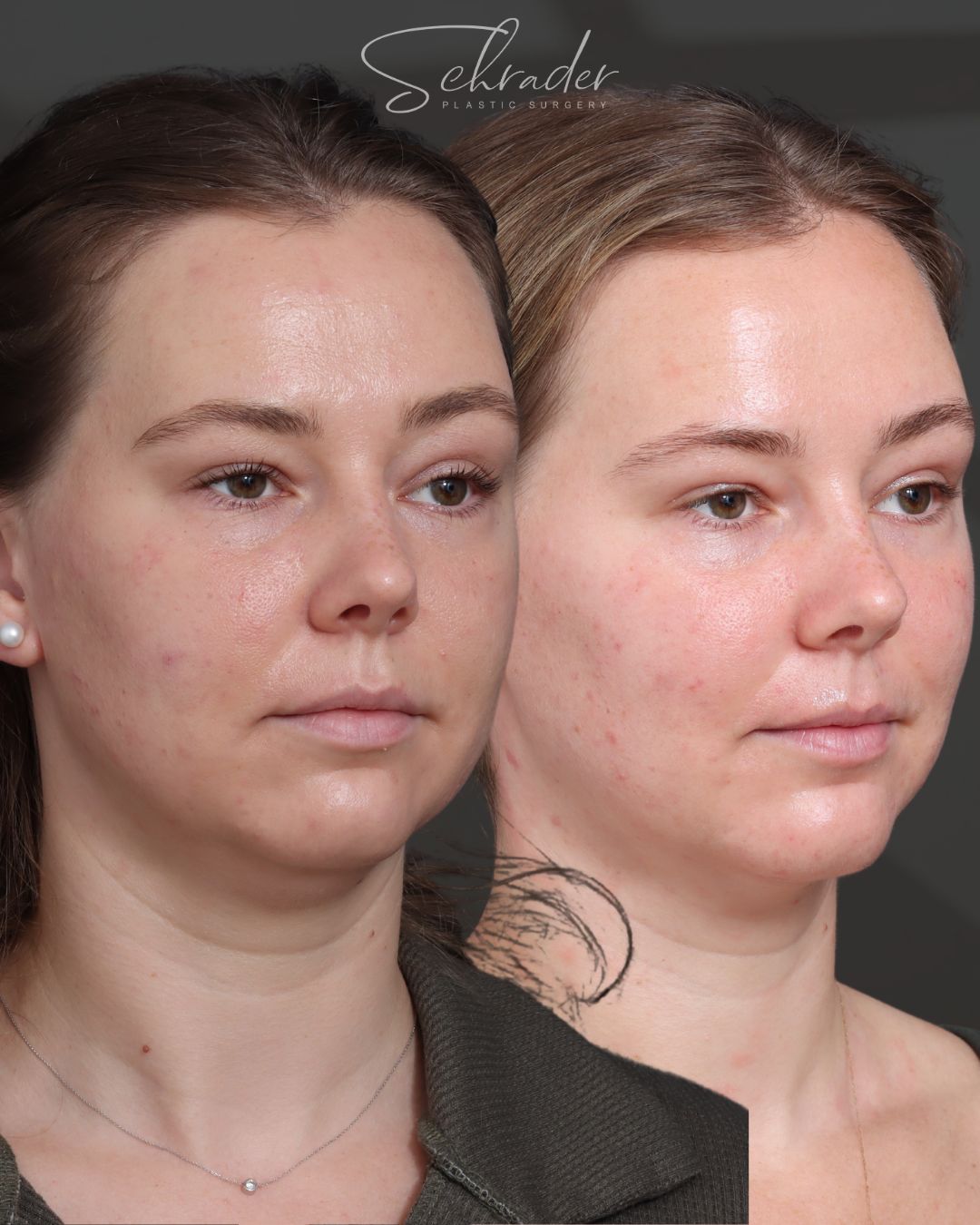 chin-liposuction-10-obl