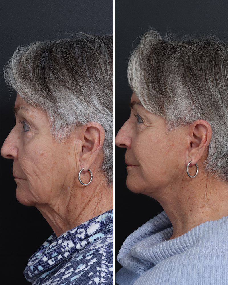 deep-plane-facelift-01-obl-left