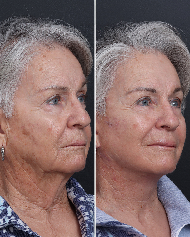 deep-plane-facelift-01-obl-right