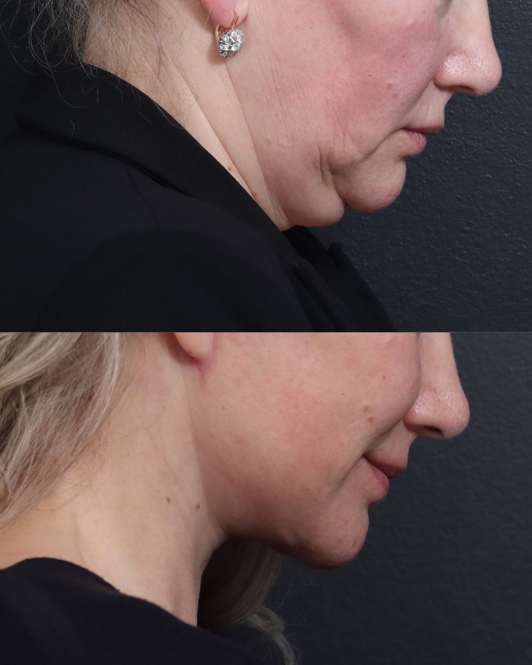 deep-plane-facelift-06-lat