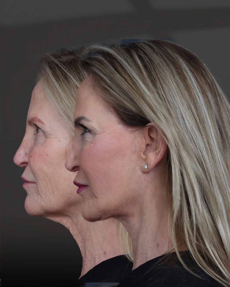 deep-plane-facelift-and-neck-lift-05-lat