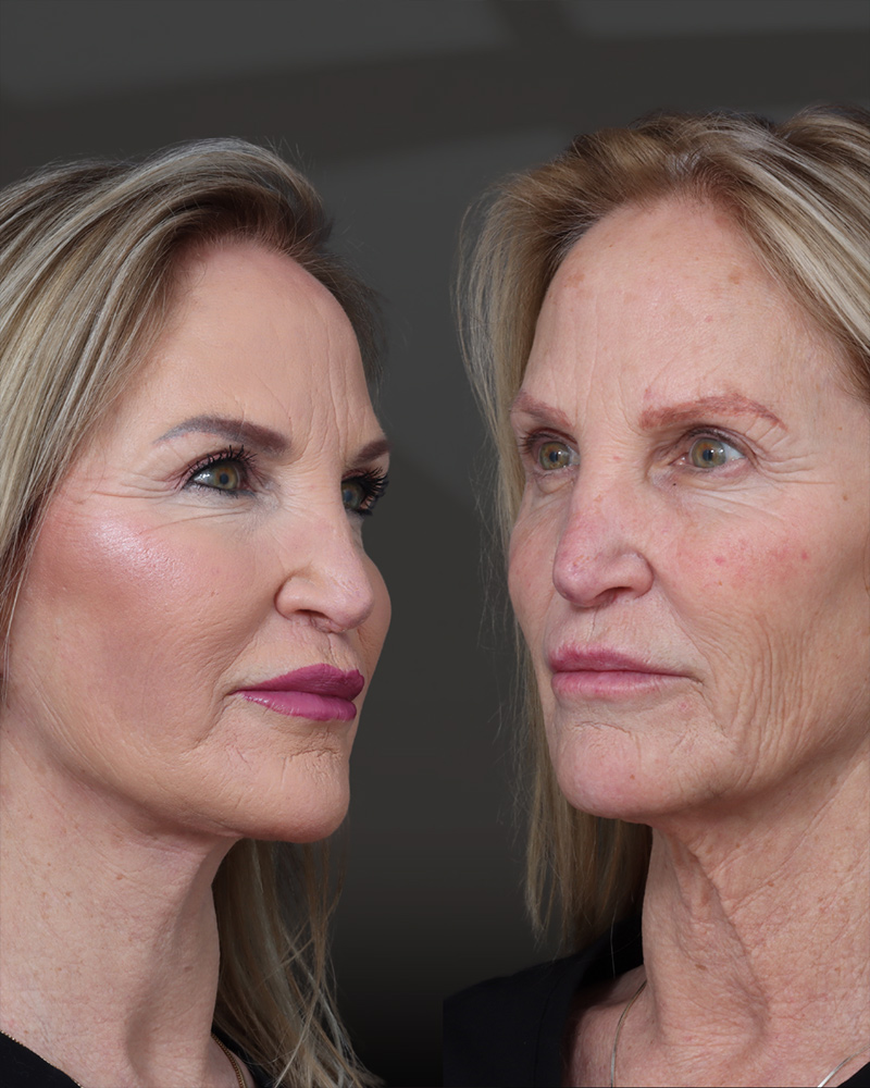 deep-plane-facelift-and-neck-lift-05-obl