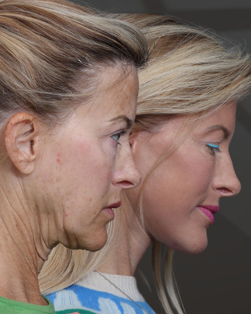 deep-plane-facelift-and-neck-lift-lat-r