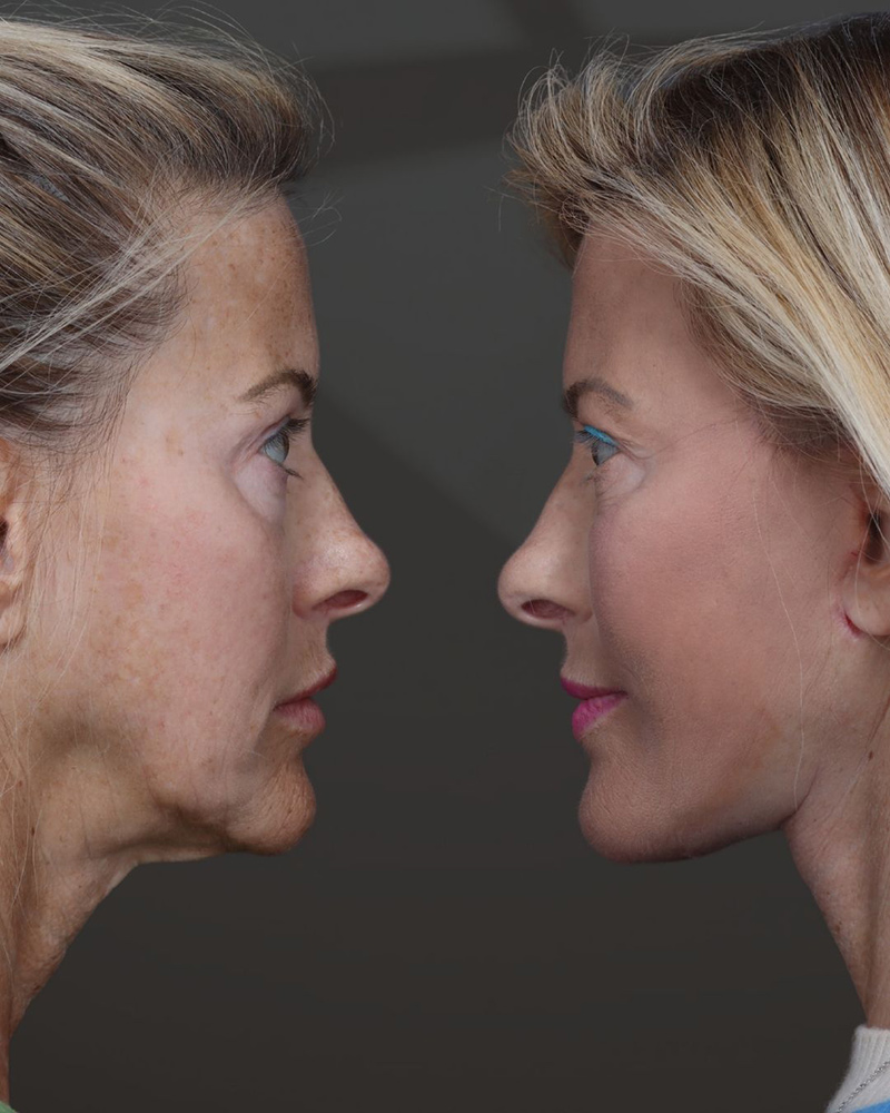 deep-plane-facelift-and-neck-lift-lat