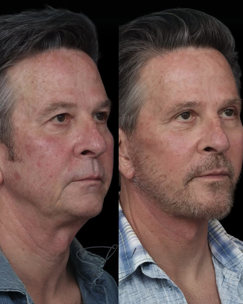 deep-plane-facelift-chin-implant-01-front