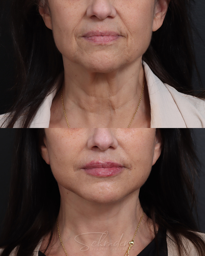 deep-plane-facelift-necklift-04-front