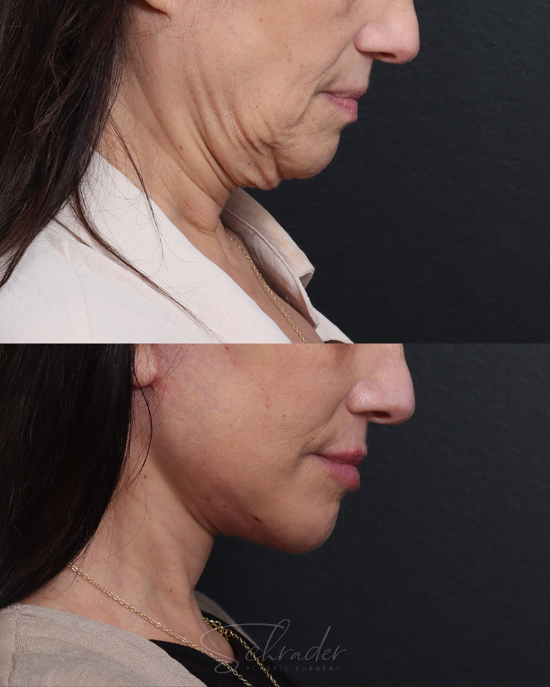 deep-plane-facelift-necklift-04-lat