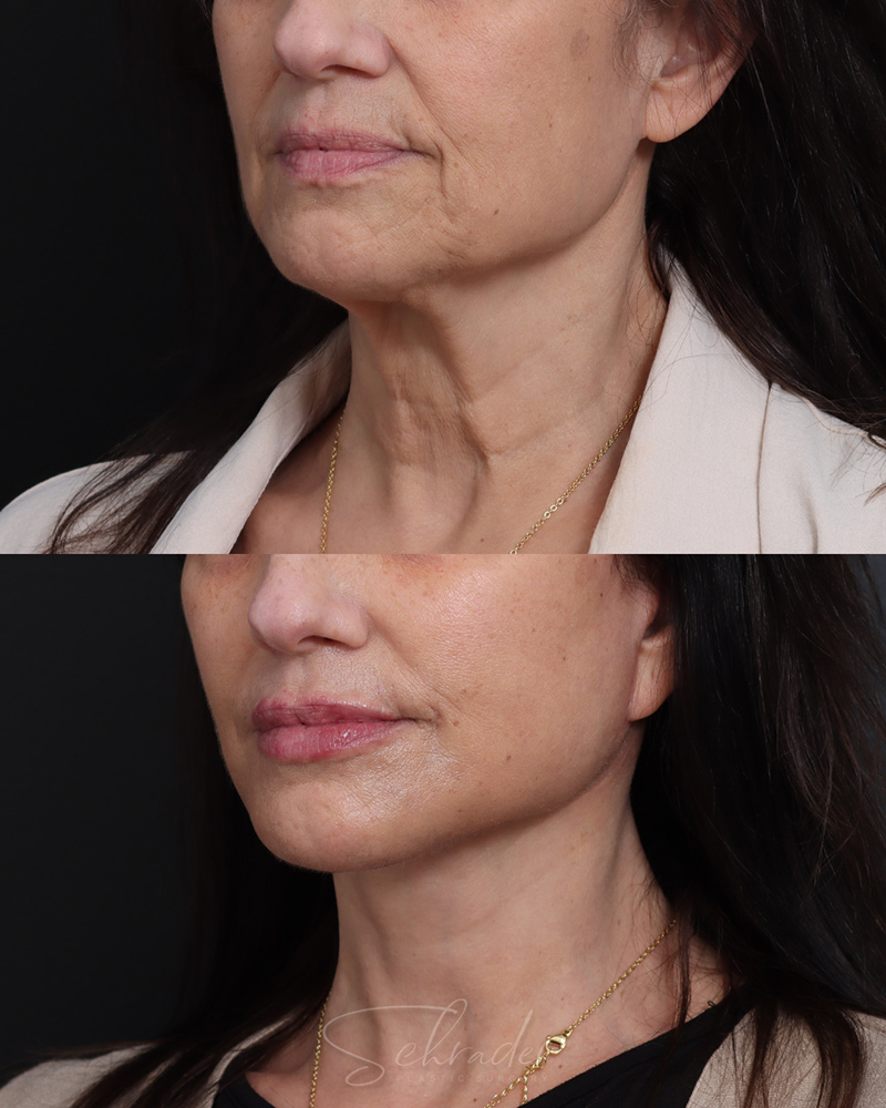deep-plane-facelift-necklift-04-obl