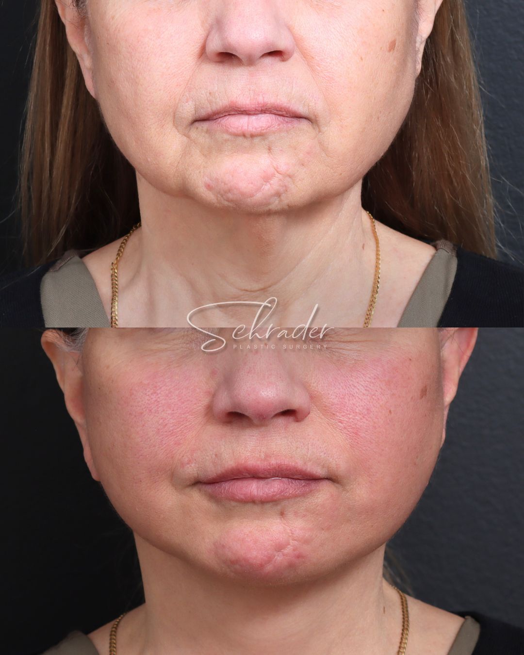 deep-plane-facelift-necklift-front