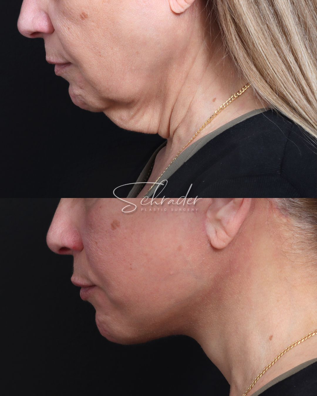 deep-plane-facelift-necklift-lat