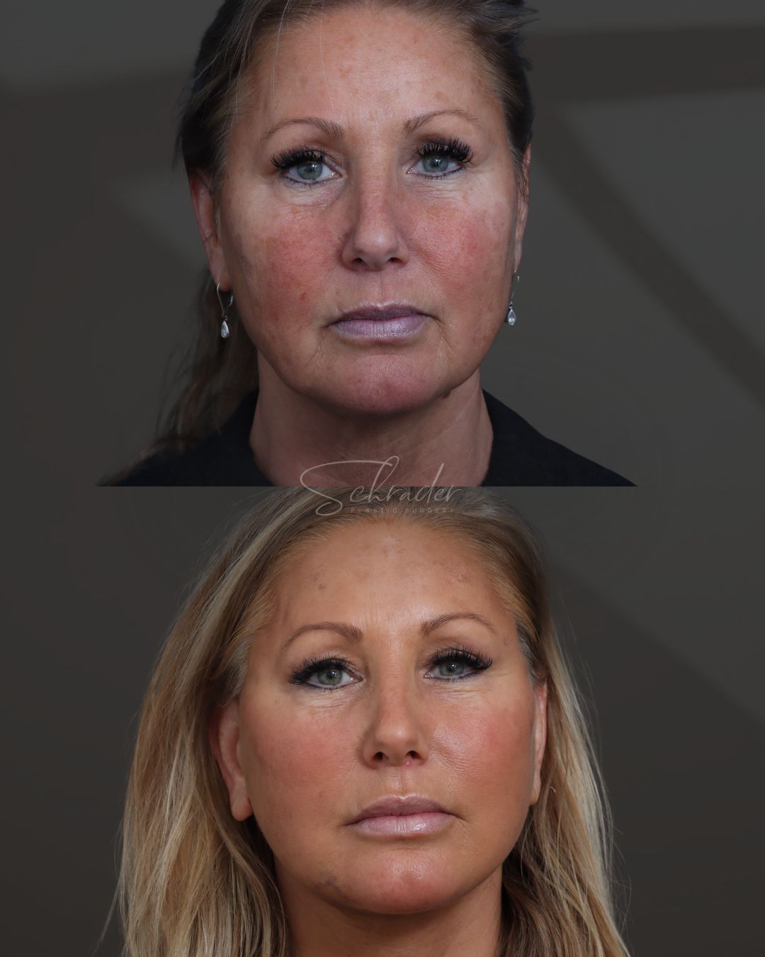 face-necklift-06-front