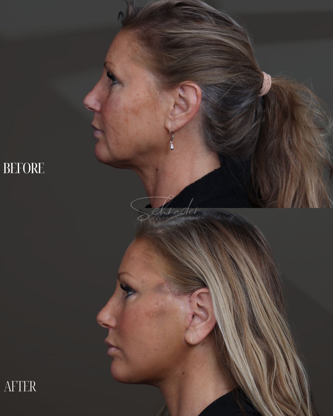 face-necklift-06-lat