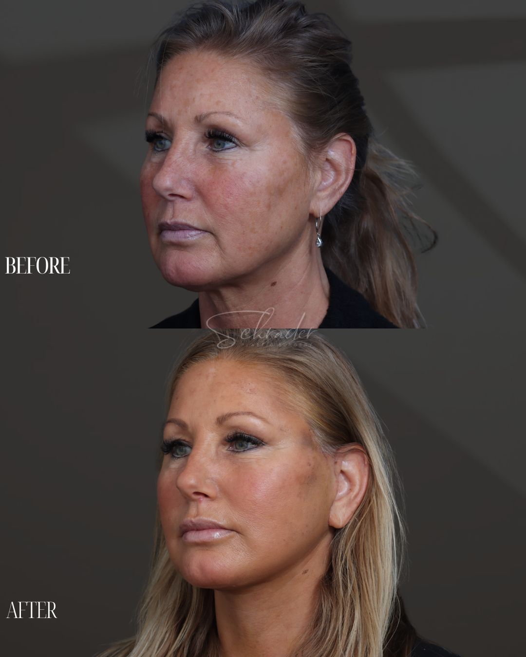 face-necklift-06-obl