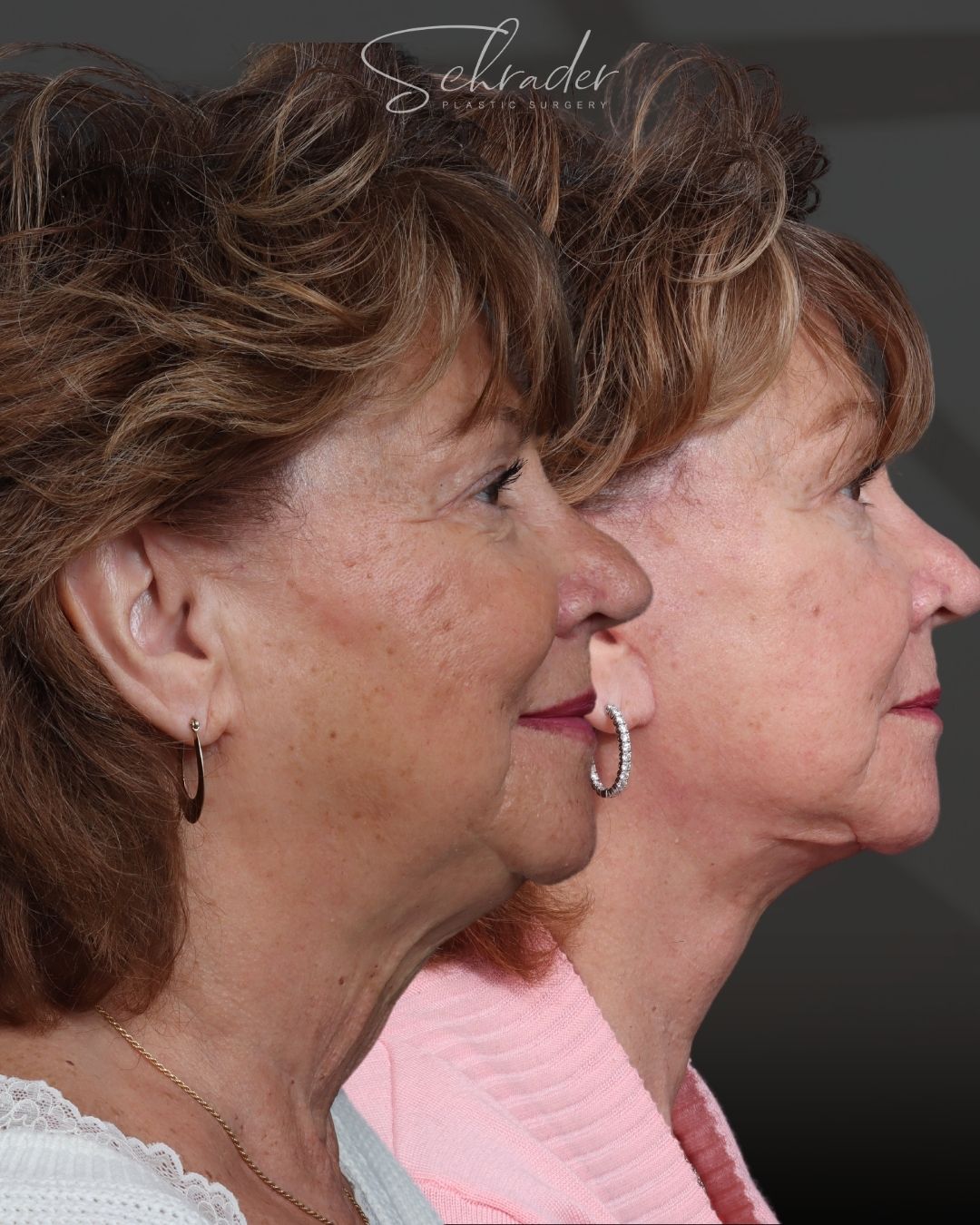facelift-20-lat