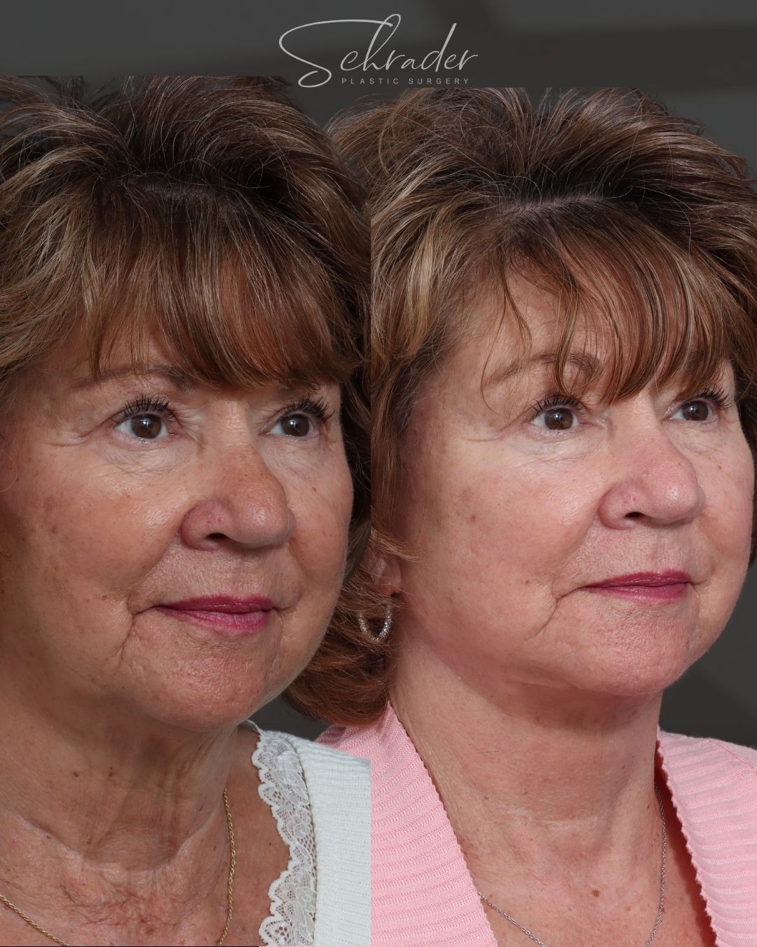 facelift-20-obl