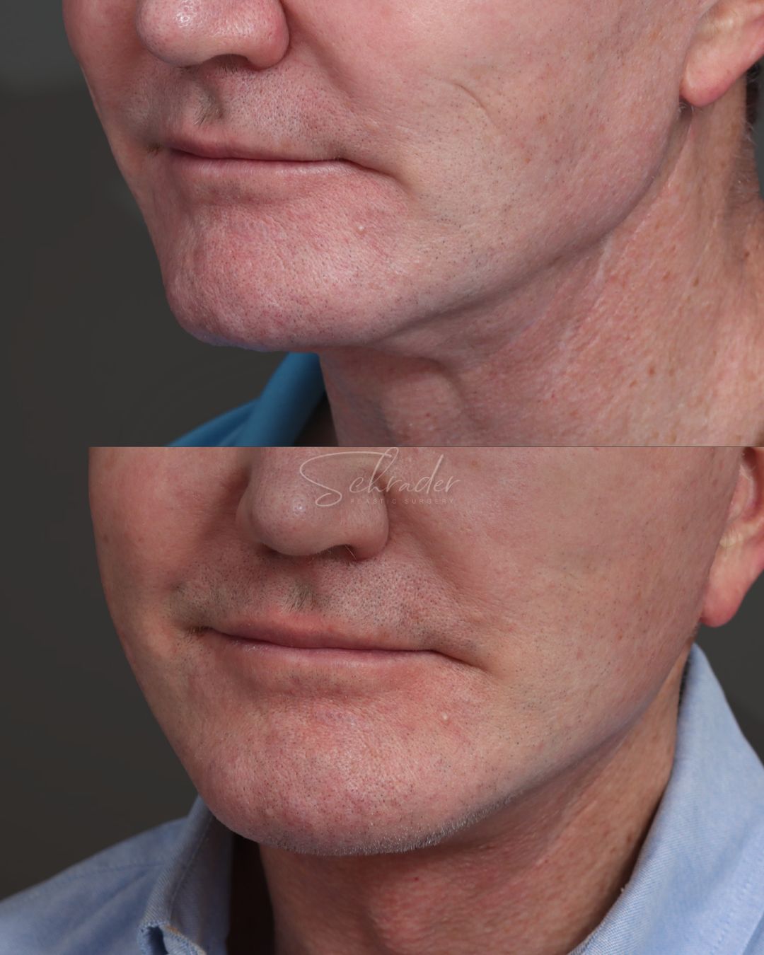 facelift-necklift-01-obl-left