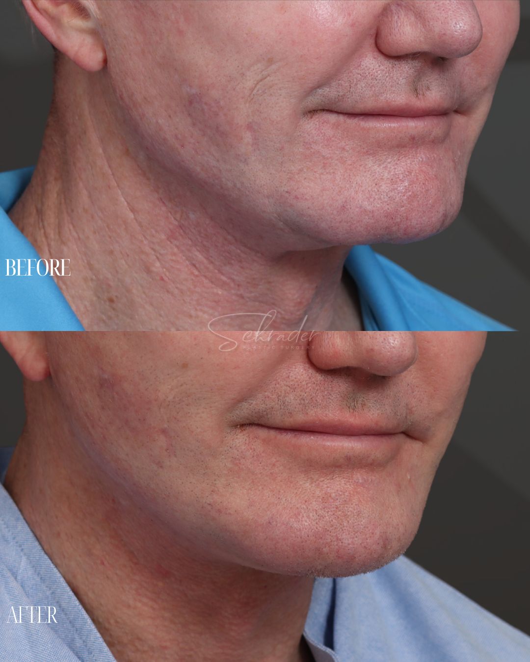 facelift-necklift-01-obl-right