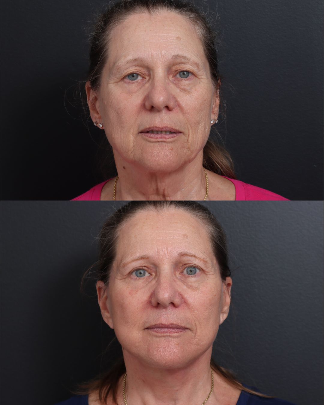 facelift-necklift-02-front