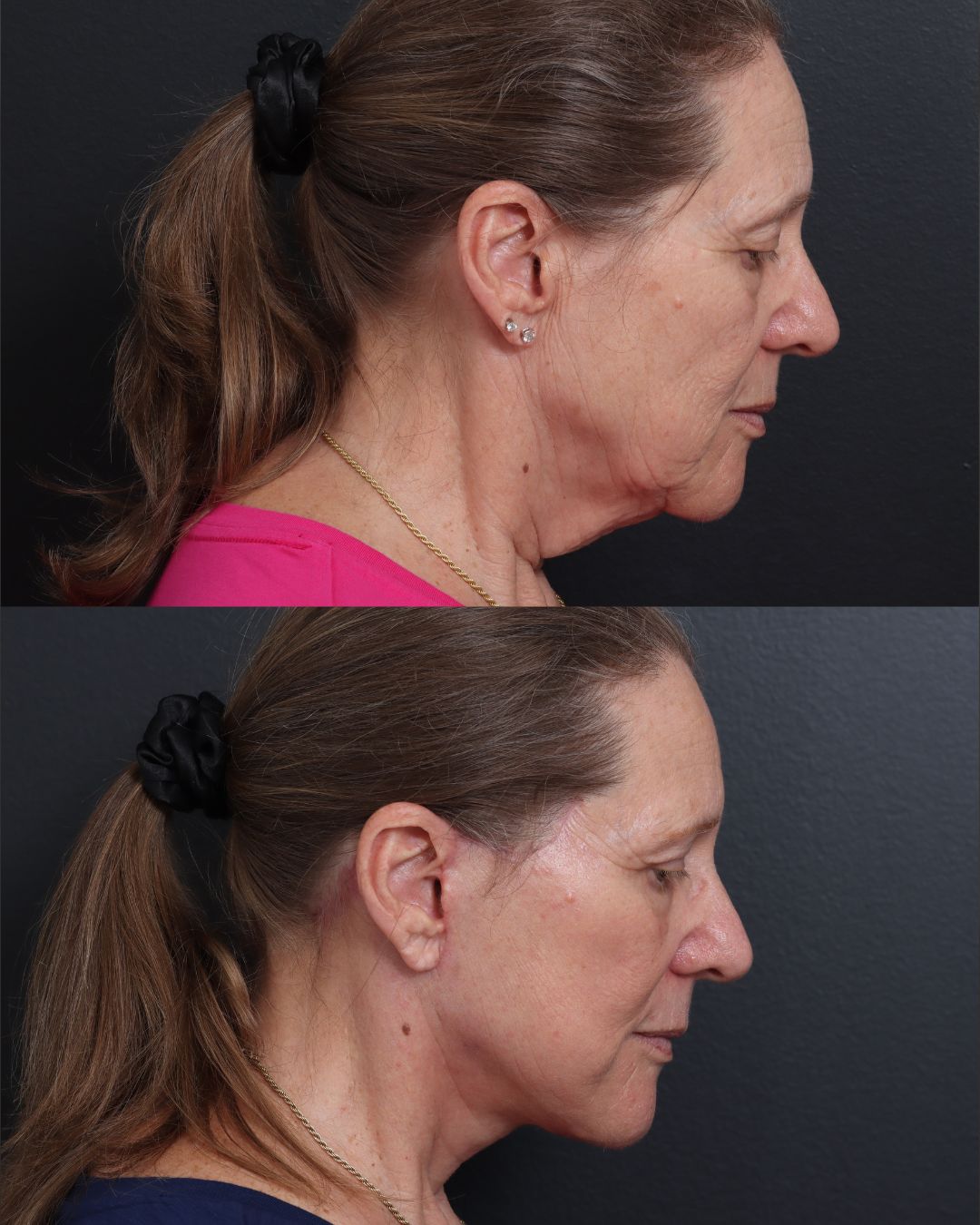facelift-necklift-02-lat1