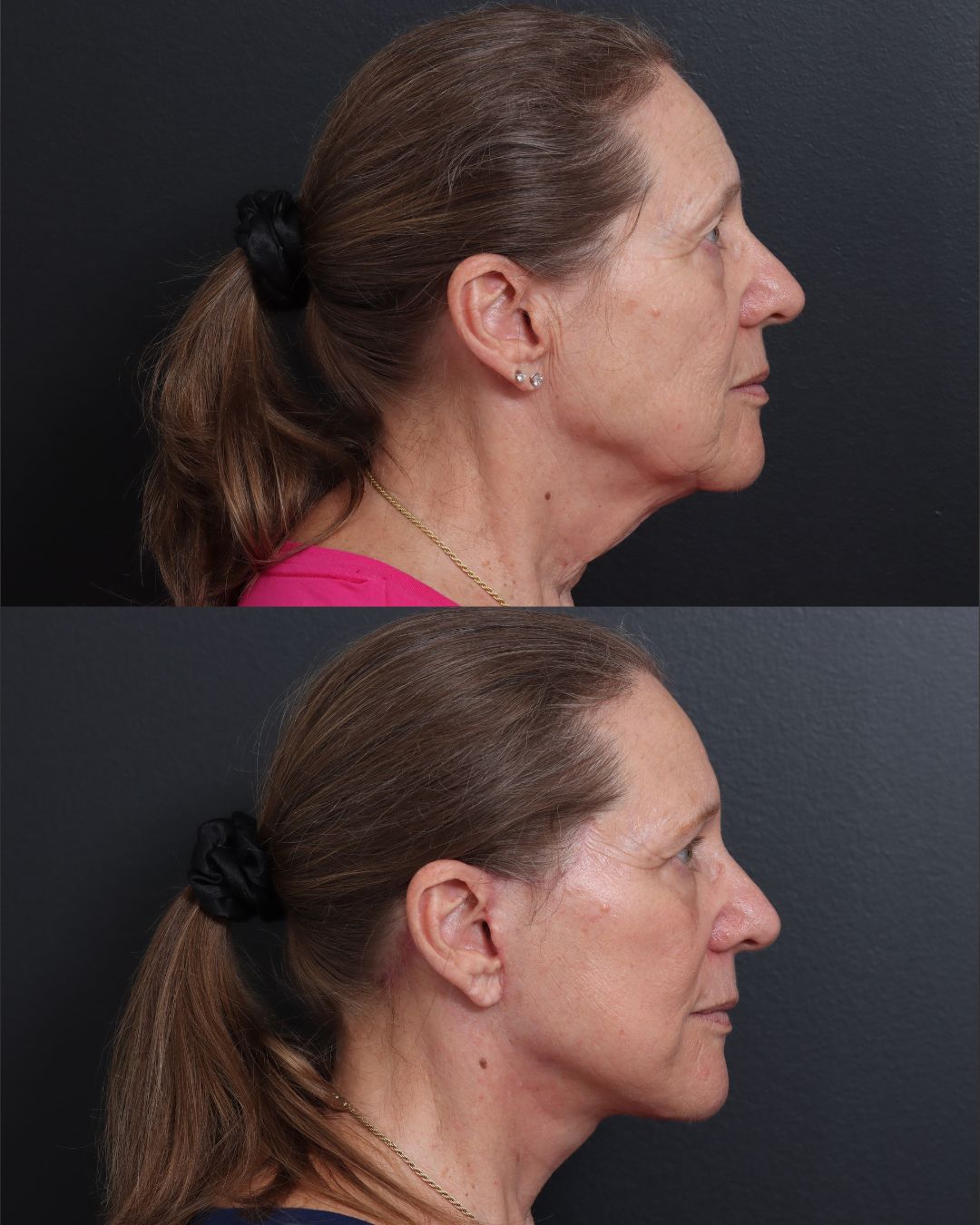 facelift-necklift-02-lat2