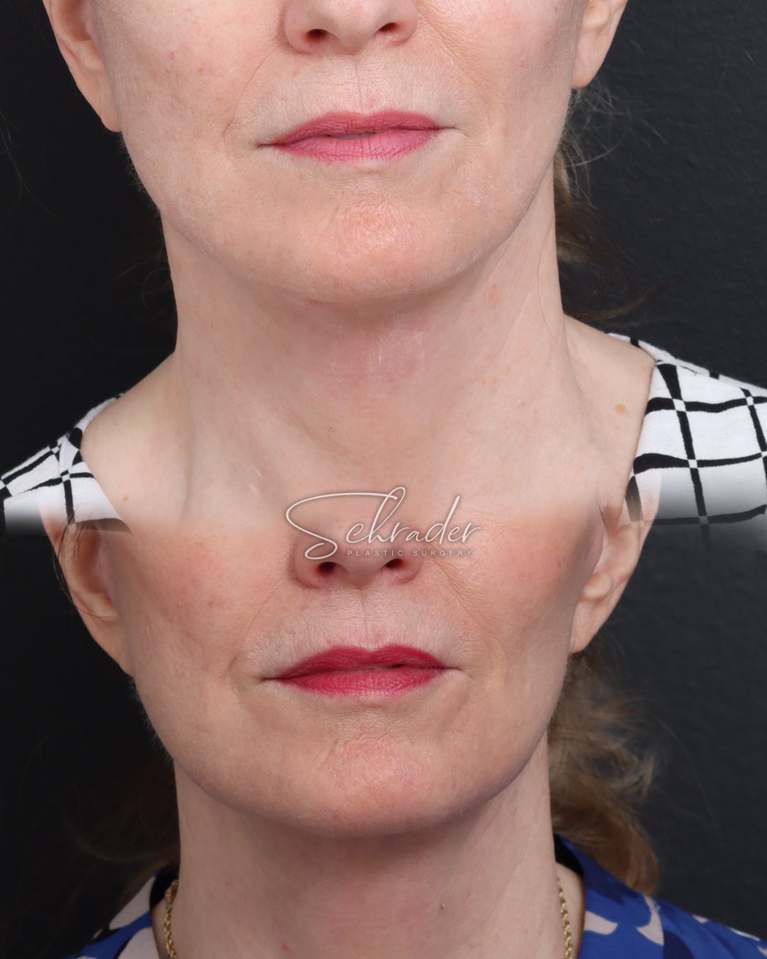 facelift-necklift-03-front