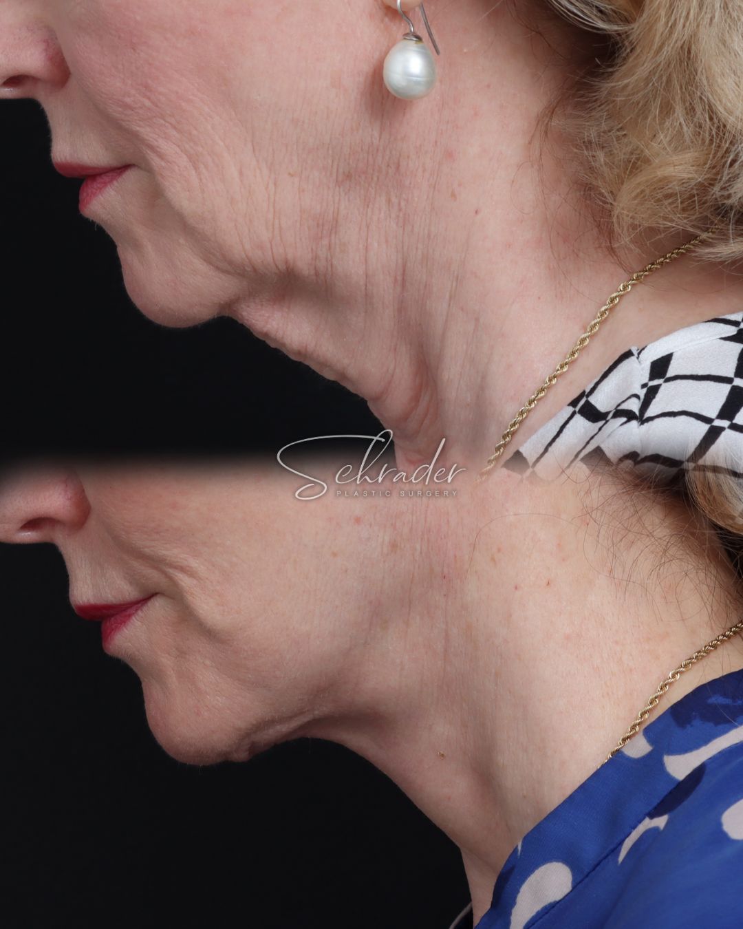facelift-necklift-03-lat-l