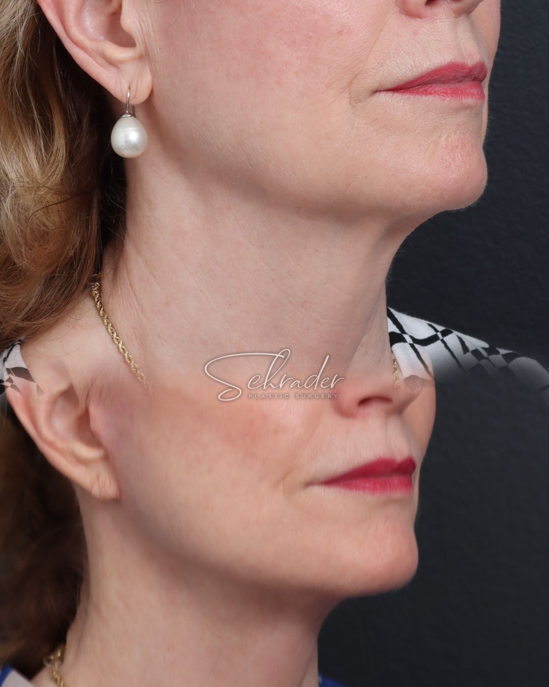 facelift-necklift-03-lat-r