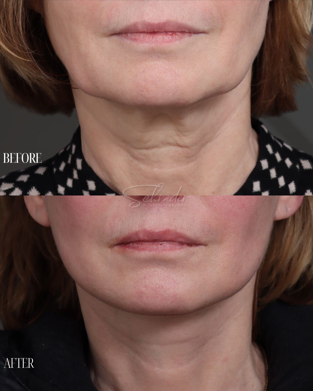Dr Schrader Before/Afters - Lucia Fedina (lower face) (2)