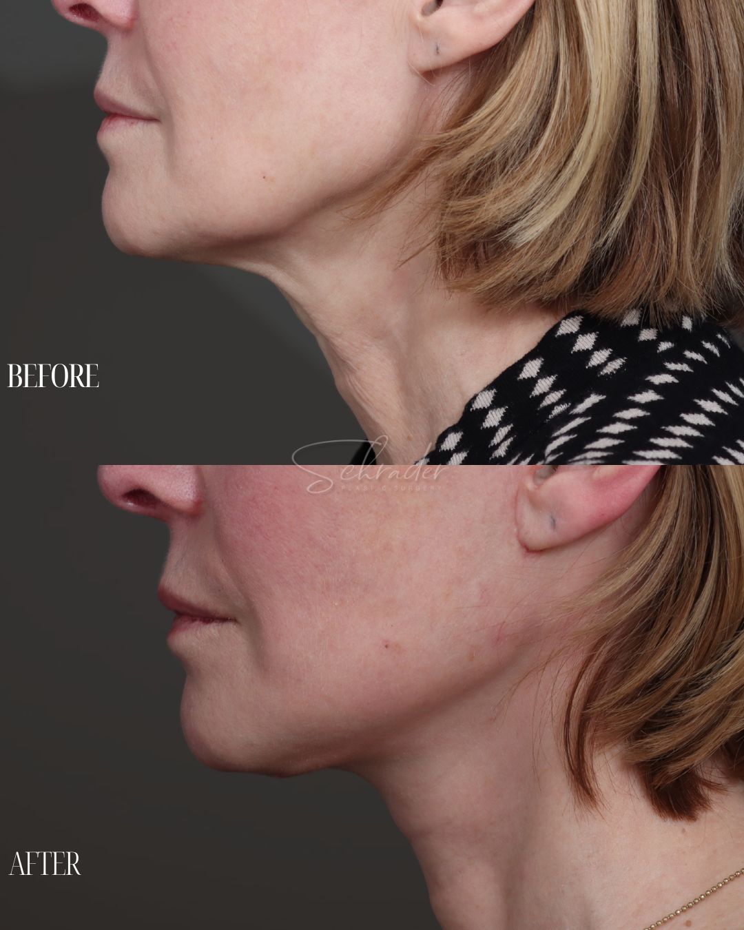Dr Schrader Before/Afters - Lucia Fedina (lower face) (4)