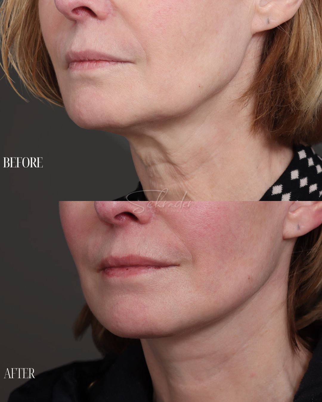 Dr Schrader Before/Afters - Lucia Fedina (lower face) (3)