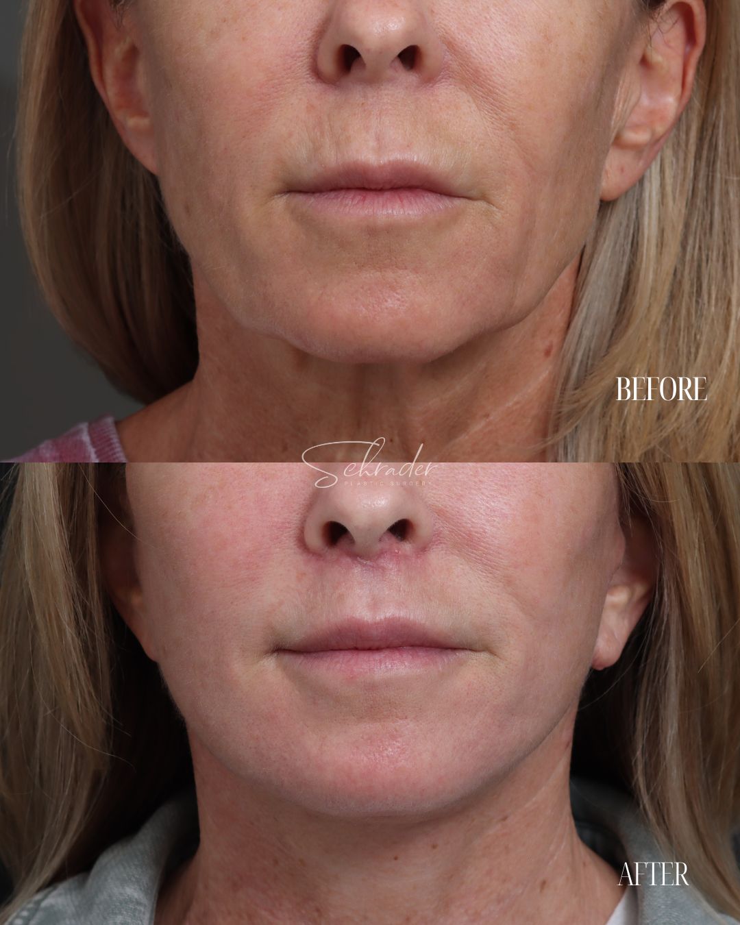 Dr Schrader Before/Afters - Jeanine Reilly (lower face) (2)