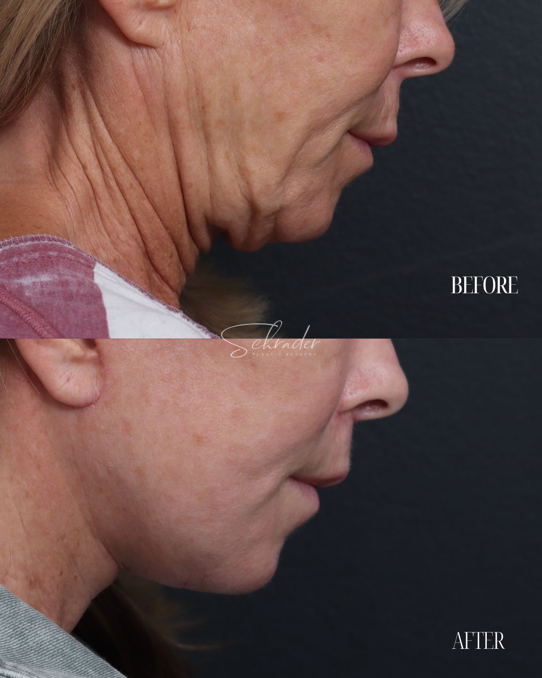 Dr Schrader Before/Afters - Jeanine Reilly (lower face) (4)